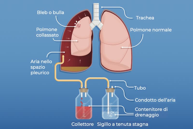 Illustrazione di un polmone sano e un polmone collassato con aria all'interno dello spazio pleurico e nel lato inferiore due contenitori, un collettore e un sigillo a tenuta stagna per drenare il liquido toracico