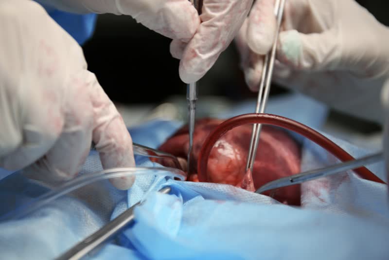 Mani di un'equipe medica impegnata in sala operatoria in un'operazione di trapianto di cuore su paziente con torace aperto e cuore in vista