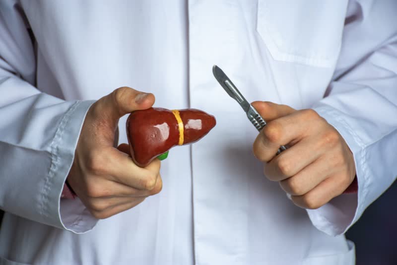 Foto di un medico con in mano un bisturi e un modello di fegato per rappresentare la resezione epatica