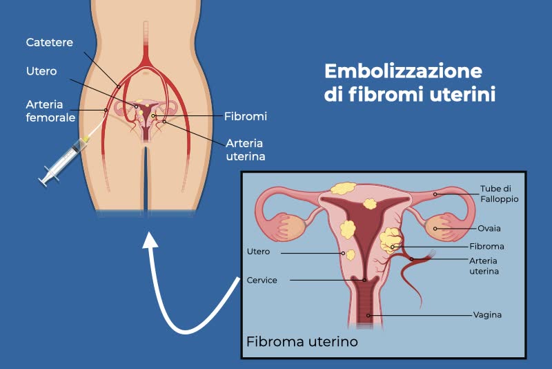 Illustrazione del processo di embolizzazione di fibromi uterini con a sinistra il disegno di un corpo femminile con focus sull'apparato riproduttivo e a destra un ingrandimento di un utero affetto da fibromi