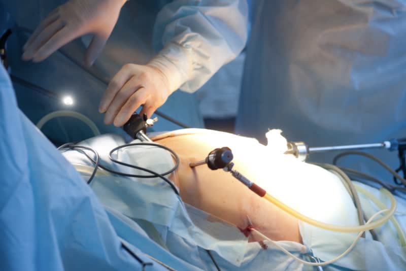 Equipe medica attorno ad un paziente addormentato in sala operatoria con strumenti chirurgici applicati durante un intervento di cistectomia