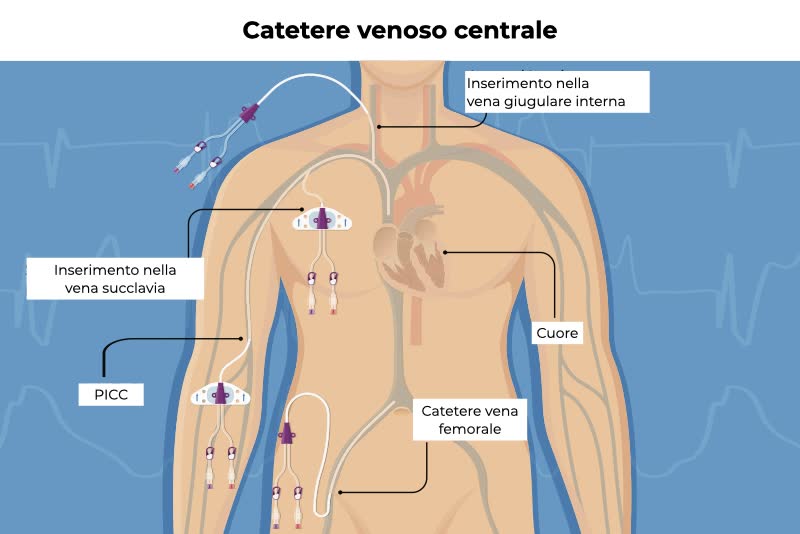 Illustrazione del catetere venoso centrale, attraverso l'inserimento del catetere nella vena giugulare interna, nella vena succlavia e inella vena femorale