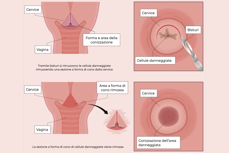 Illustrazione di un processo di conizzazione a livello uterino: con un'incisione a forma di cono (da qui il nome) si rimuove una porzione di utero danneggiata