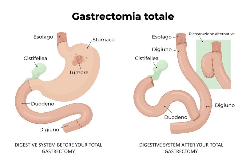Illustrazione con due stomaci e esofagi, a sinistra con tumore e stomaco ancora presente, a destra a gastrectomia eseguita