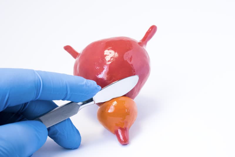 Immagine di un dottore con in mano un bisturi appoggiato su una miniatura di una vescica e di una prostata all'altezza di quest'ultima per simboleggiare la prostatectomia