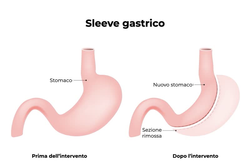 Illustrazione dello sleeve gastrico: a sinistra uno stomaco 